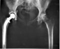 X-ray image showing hip replacement